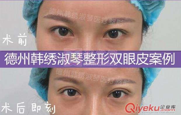 德州韓繡整形醫(yī)院，德州做雙眼皮最專業(yè)的整形醫(yī)院原始圖片2
