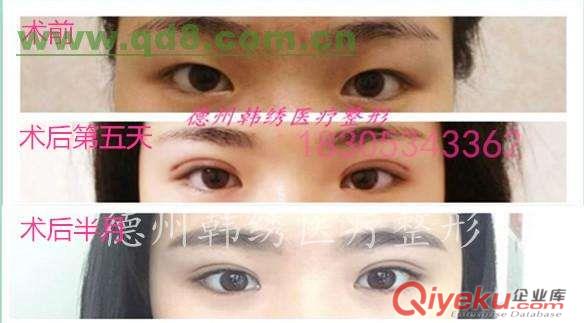 德州韓繡整形醫(yī)院，德州做雙眼皮最專業(yè)的整形醫(yī)院原始圖片3