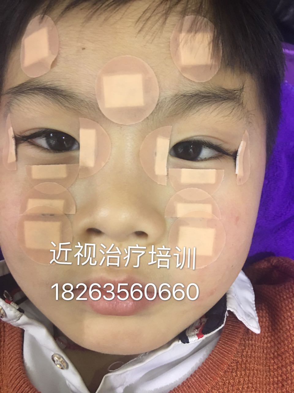 兒童弱視的zl方法原始圖片2