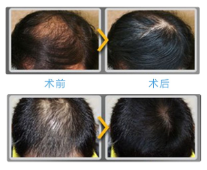 上海毛發(fā)移植培訓