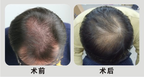 毛發(fā)移植的特點(diǎn)