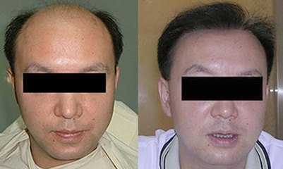 濟南毛發移植培訓