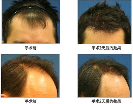 濟南納米無痕毛發移植培訓