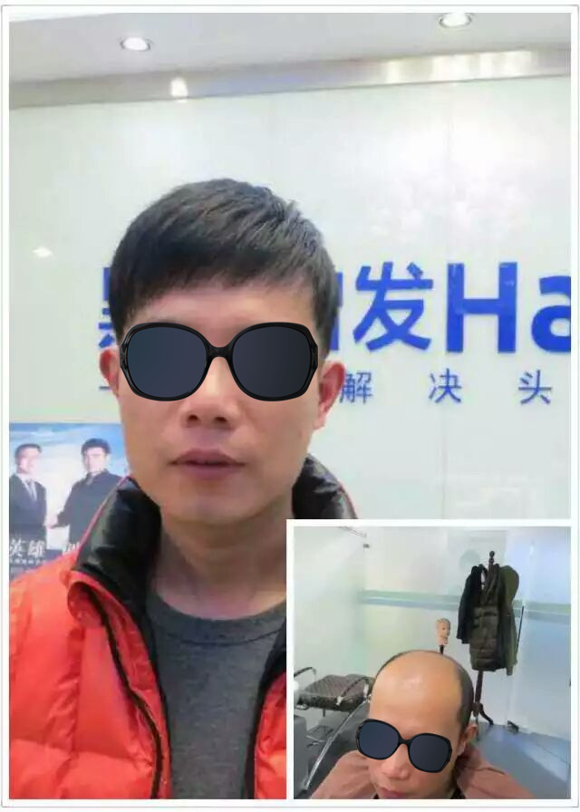 泉州補發價格？泉州補發多少錢？男士假發多少錢？