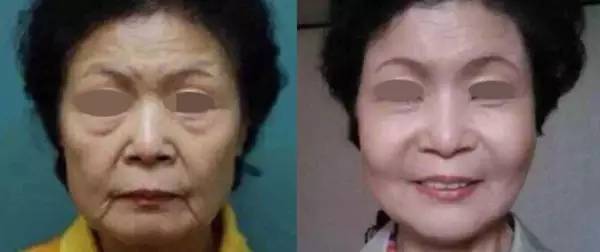 济南 线雕提升培训