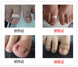 灰指甲zl：專業無創甲溝重建術推薦