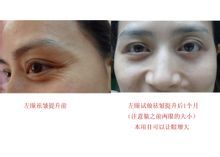 上海广州雾化去皱培训