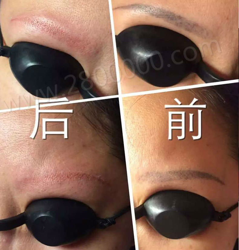 便攜款天空三號(hào)激光洗眉機(jī)洗紋身機(jī)器 黑臉娃娃美容儀器原始圖片3