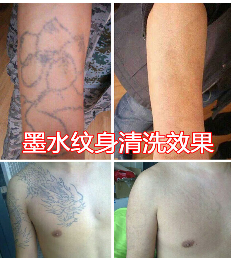 未來激光-大功率飛翔二號激光洗眉機器洗紋身機器祛斑美容儀器原始圖片3