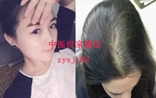 女性二十歲脫發(fā)_吃什么可以預防脫發(fā)