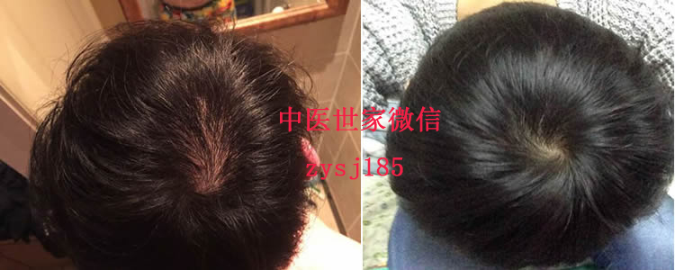 女性二十歲脫發(fā)_吃什么可以預防脫發(fā)