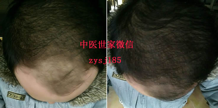 脫發(fā)可以治好嗎：廣州天欣貿(mào)易_專業(yè)zl脫發(fā)、sf機(jī)構(gòu)