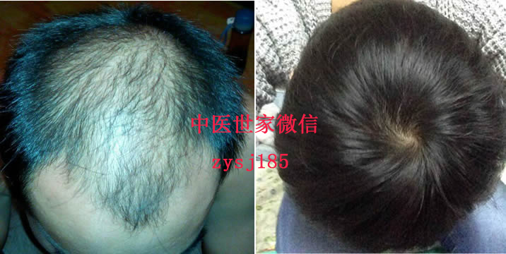 脫發(fā)可以zl嗎|廣東優(yōu)質的zl脫發(fā)、sf推薦