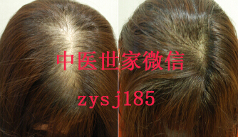 脫發(fā)可以zl嗎|廣東優(yōu)質的zl脫發(fā)、sf推薦