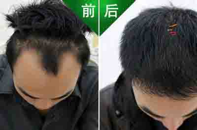 哪里有提供可靠的zl脫發(fā)、sf：脫發(fā)的原因是什么