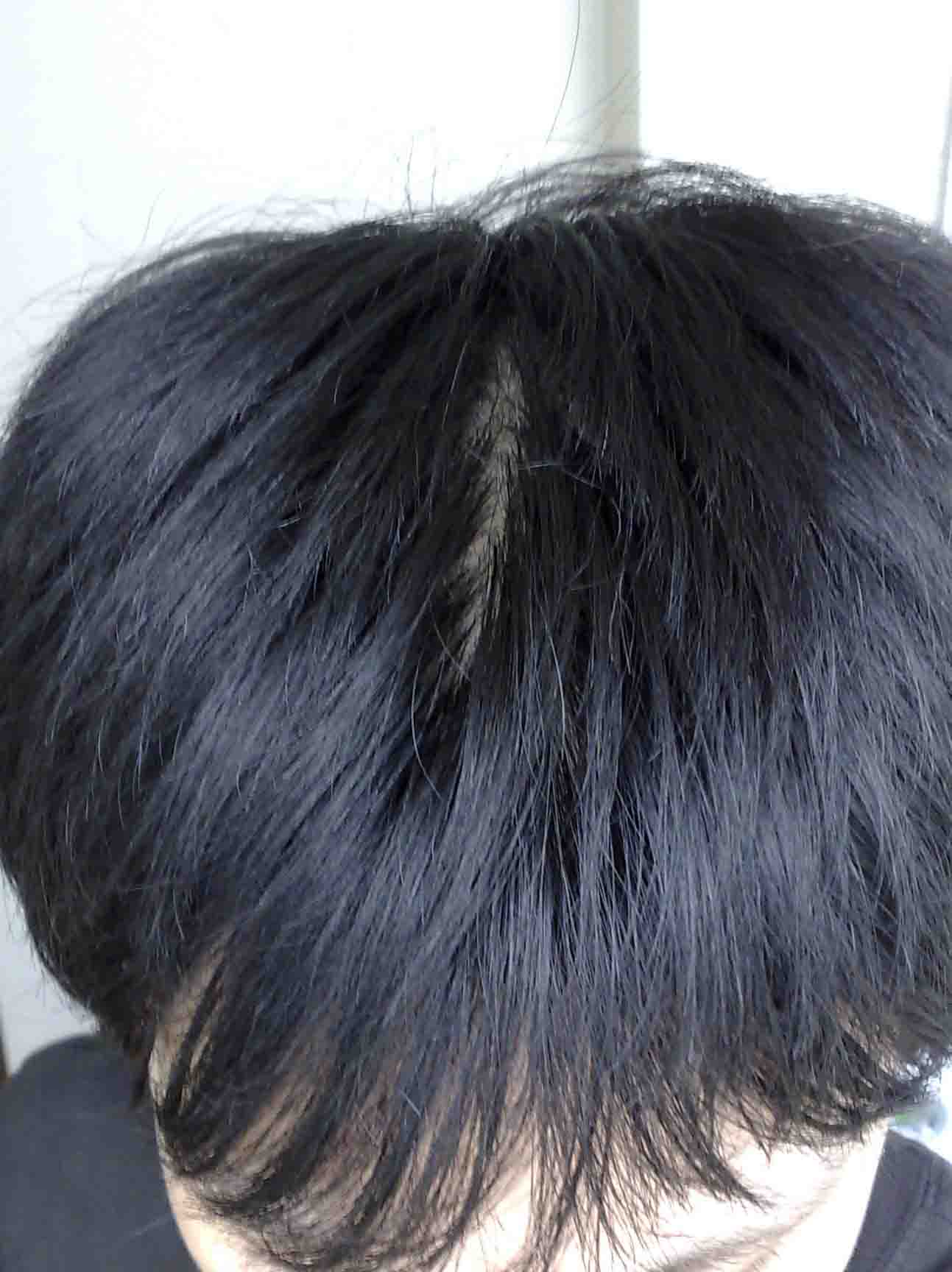 脫發(fā)很嚴重怎么：放心的治療脫發(fā)、生發(fā)推薦